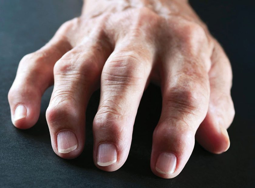 روماتیسم مفصلی چیست؟