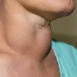 التهاب تیروئید (تیروئیدیت)