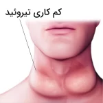 کم کاری تیروئید + علل، عوارض