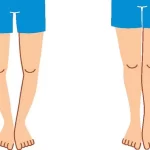 علل ایجاد زانو یا پای پرانتزی چیست؟