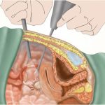 برداشتن رحم در رابطه زناشویی