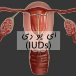آی یو دی (IUD) یا دستگاه جلوگیری از بارداری چیست؟