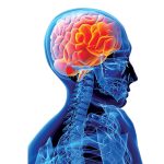 سکته مغزی در زنان و مردان