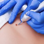 کرایوتراپی زگیل تناسلی: درمان سریع و موثر