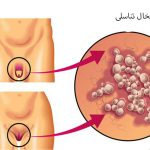 تبخال تناسلی مردان: علائم، درمان