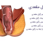 زگیل مقعدی؛ علائم، علل و روش‌های درمان