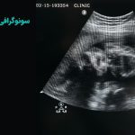سونوگرافی رحم و تخمدان